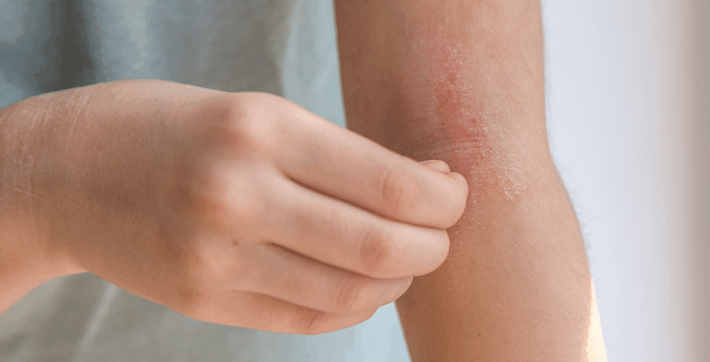 Girl scratching eczema spot on her arm.