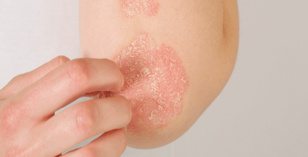 Girl scratching a patch of psoriasis on her elbow.